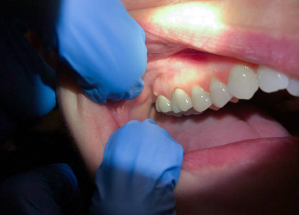 Best Emergency Tooth Extraction in Pennside, PA